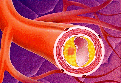 Course Image Ipercolesterolemia: aspetti consolidati e nuovi approcci diagnostici e terapeutici